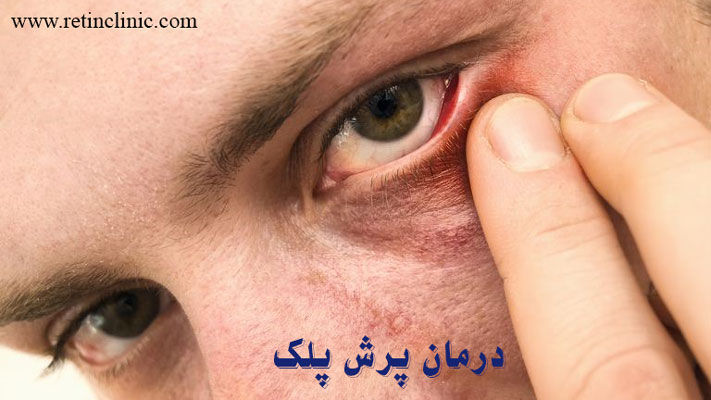 درمان پرش پلک