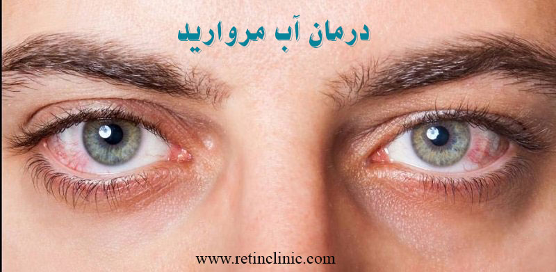 درمان آب مروارید چشم