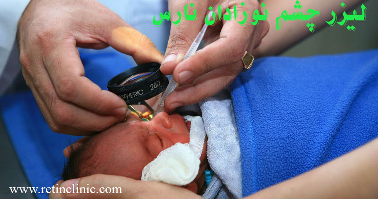 لیزر چشم نوزادان نارس