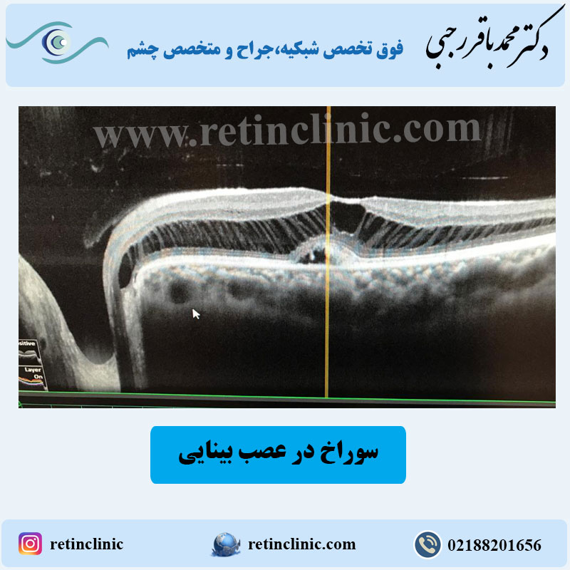 سوراخ در عصب بينايی