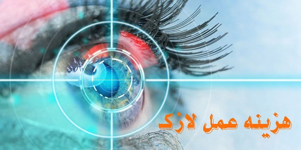 هزینه عمل لازک