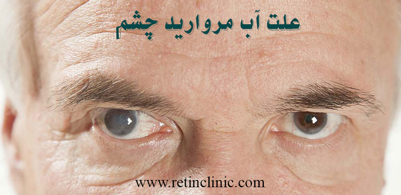 علت آب مروارید چشم