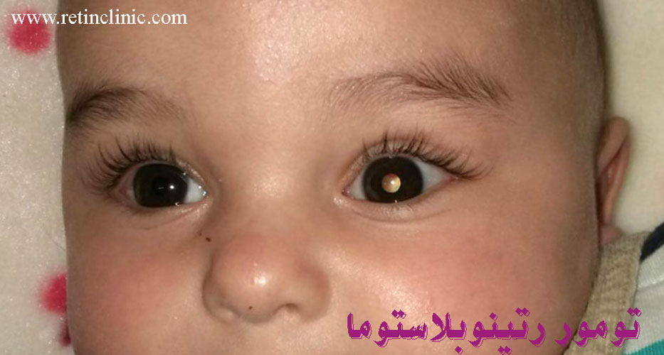 تومور رتینوبلاستوما 
