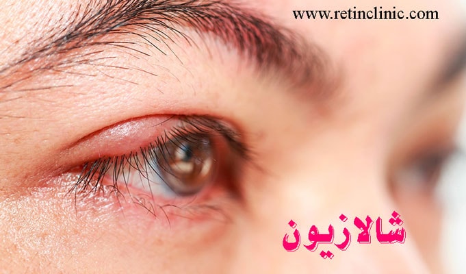 شالازیون