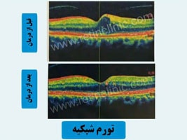 درمان تورم شبکیه در بیمار 65 ساله