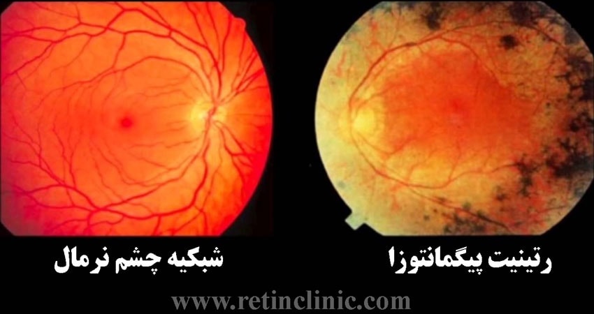 رتینیت پیگمانتوزا