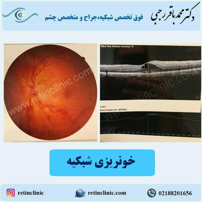 خونریزی شبکیه