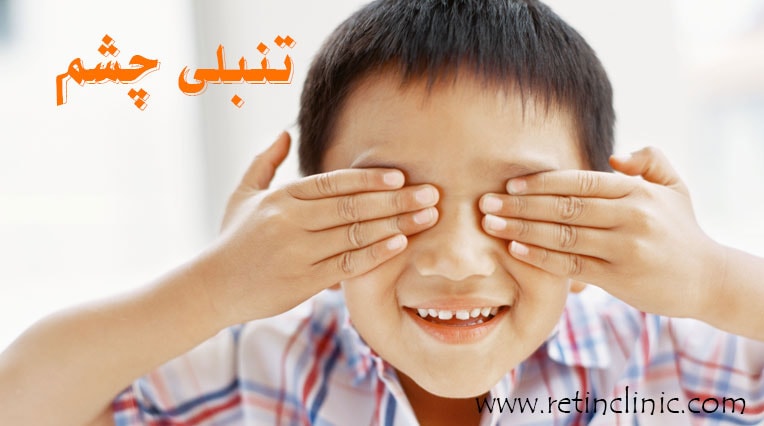 تنبلی چشم