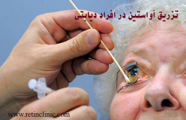 تزریق آواستین در چشم افراد دیابتی