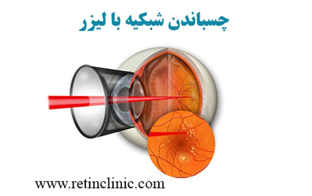  درمان پارگی شبکیه