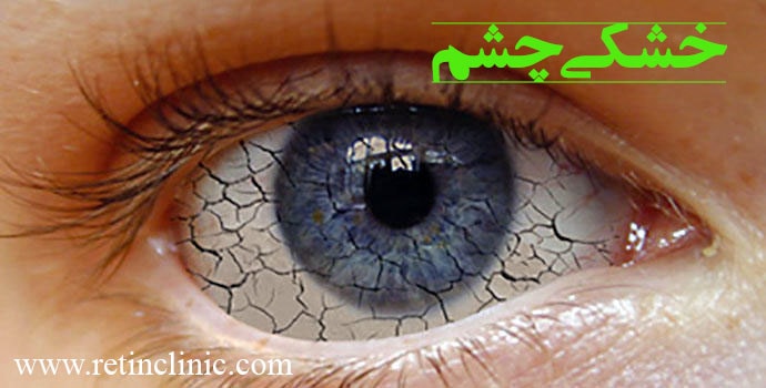 خشکی چشم