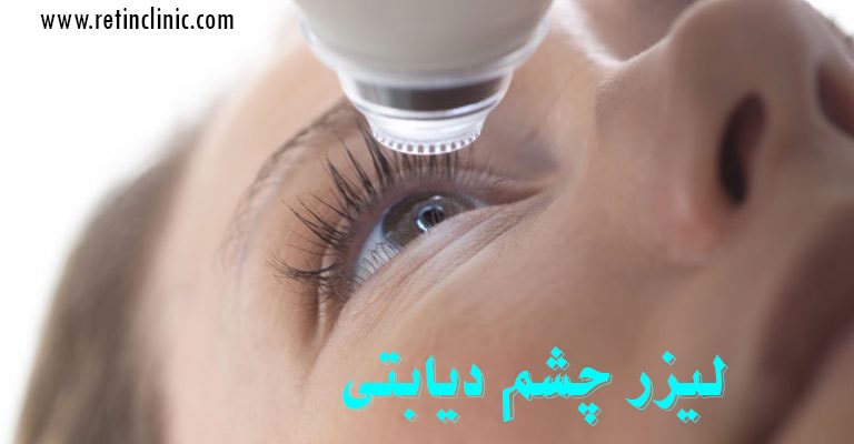لیزر چشم دیابتی