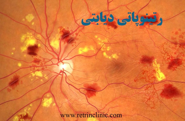 رتینوپاتی دیابتی چیست ؟