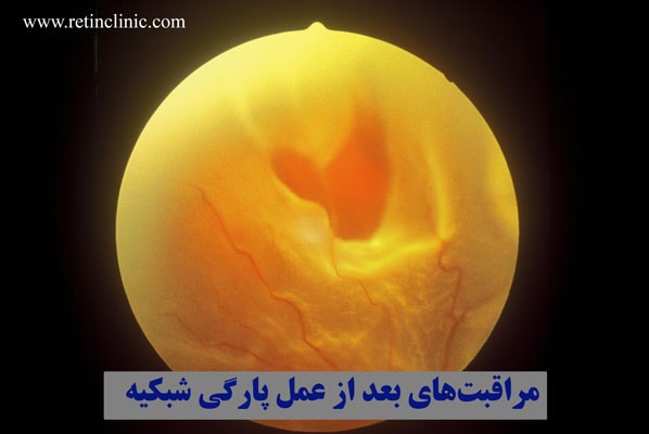 مراقبتهای بعد از عمل پارگی شبکیه