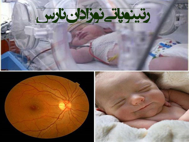 رتینوپاتی نوزادان نارس