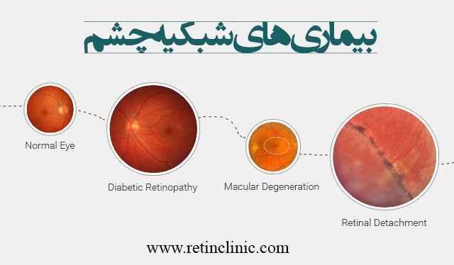 بیماریهای شبکیه چشم