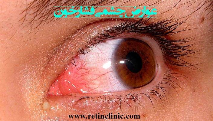 عوارض چشمی فشار خون