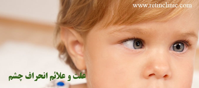 علت و علائم انحراف چشم