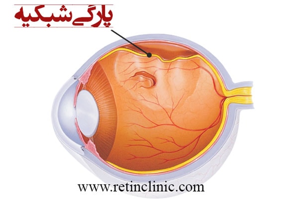پارگی شبکیه