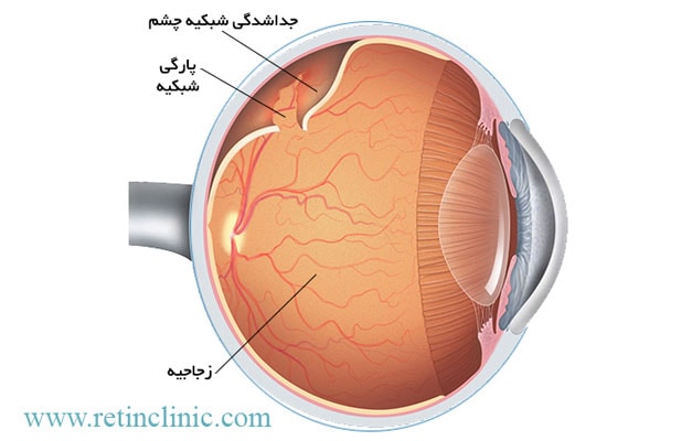 پارگی شبکیه
