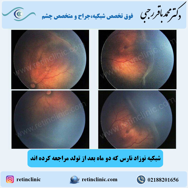 رتینوپاتی نوزاد نارس